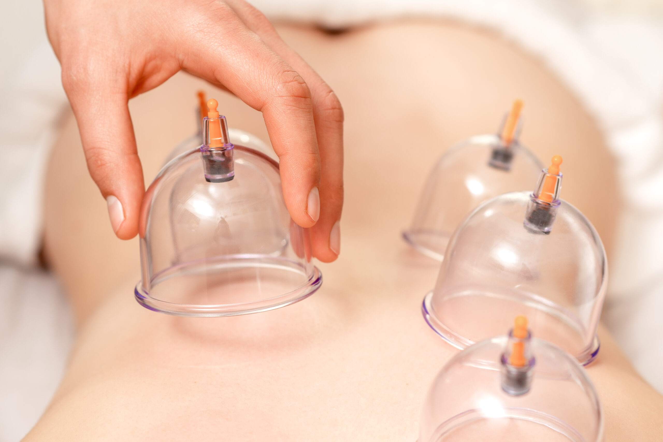 Vacuum cups of medical cupping therapy on woman back, close up, chinese medicine.