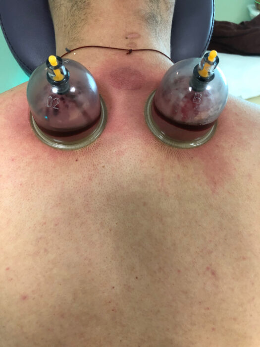 Hijama Wet Cupping Nottingham Riverside Natural Health Centre