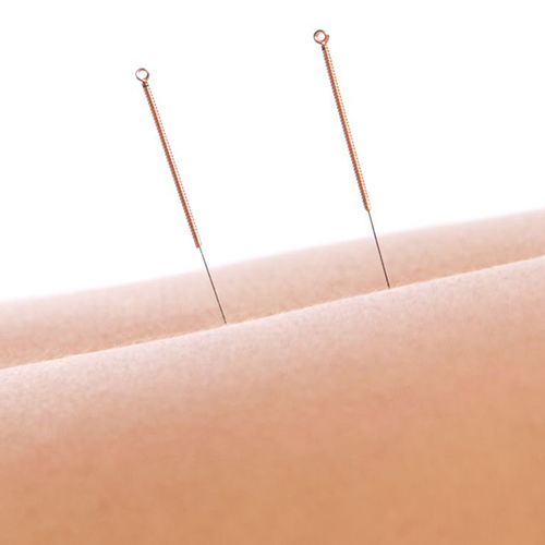 Acupuncture can help with the menopause
