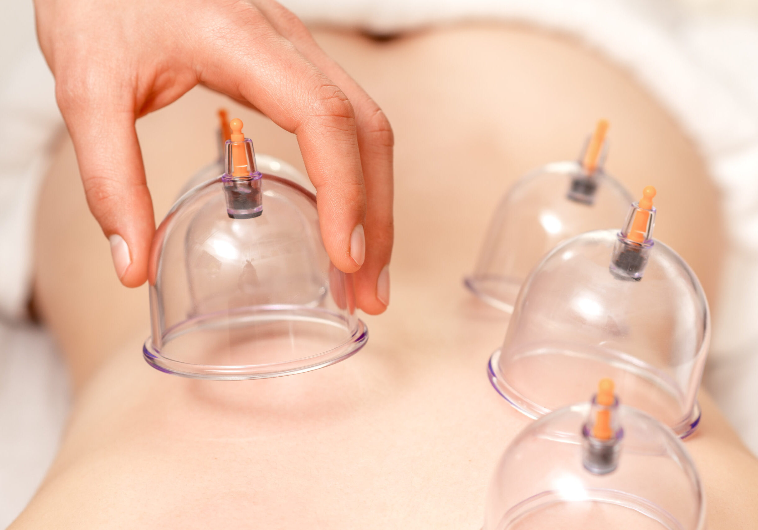 Vacuum cups of medical cupping therapy on woman back, close up, chinese medicine.