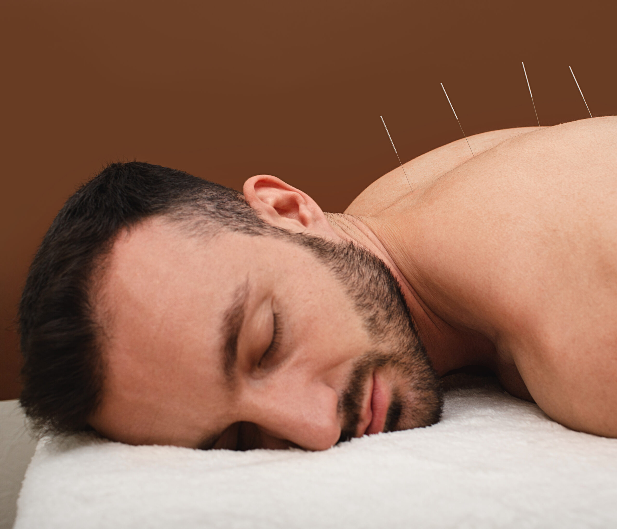 Acupuncture treatment in Nottingham